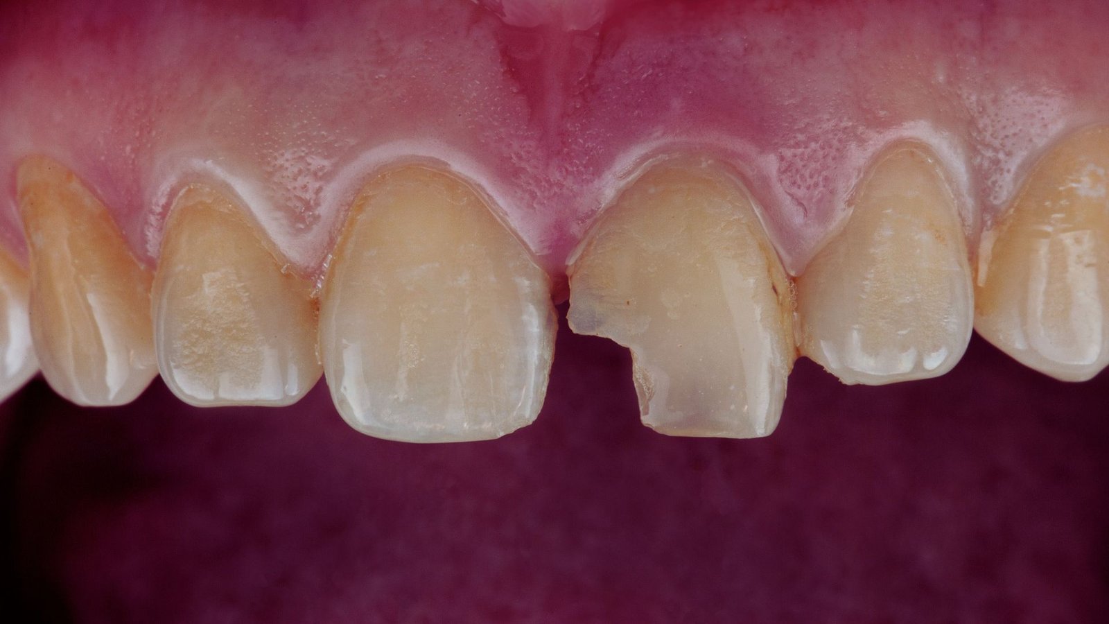 How to Fix a Chipped Denture Tooth?