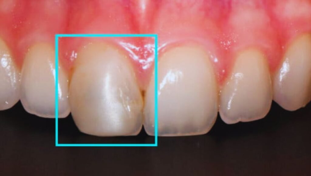 How to Fix Cavity on Front Tooth