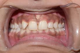 Can I Chew Gum After a Tooth Extraction