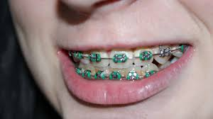 Can Braces Close a Missing Tooth Gap