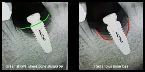 How to Fix Dental Implant Failure